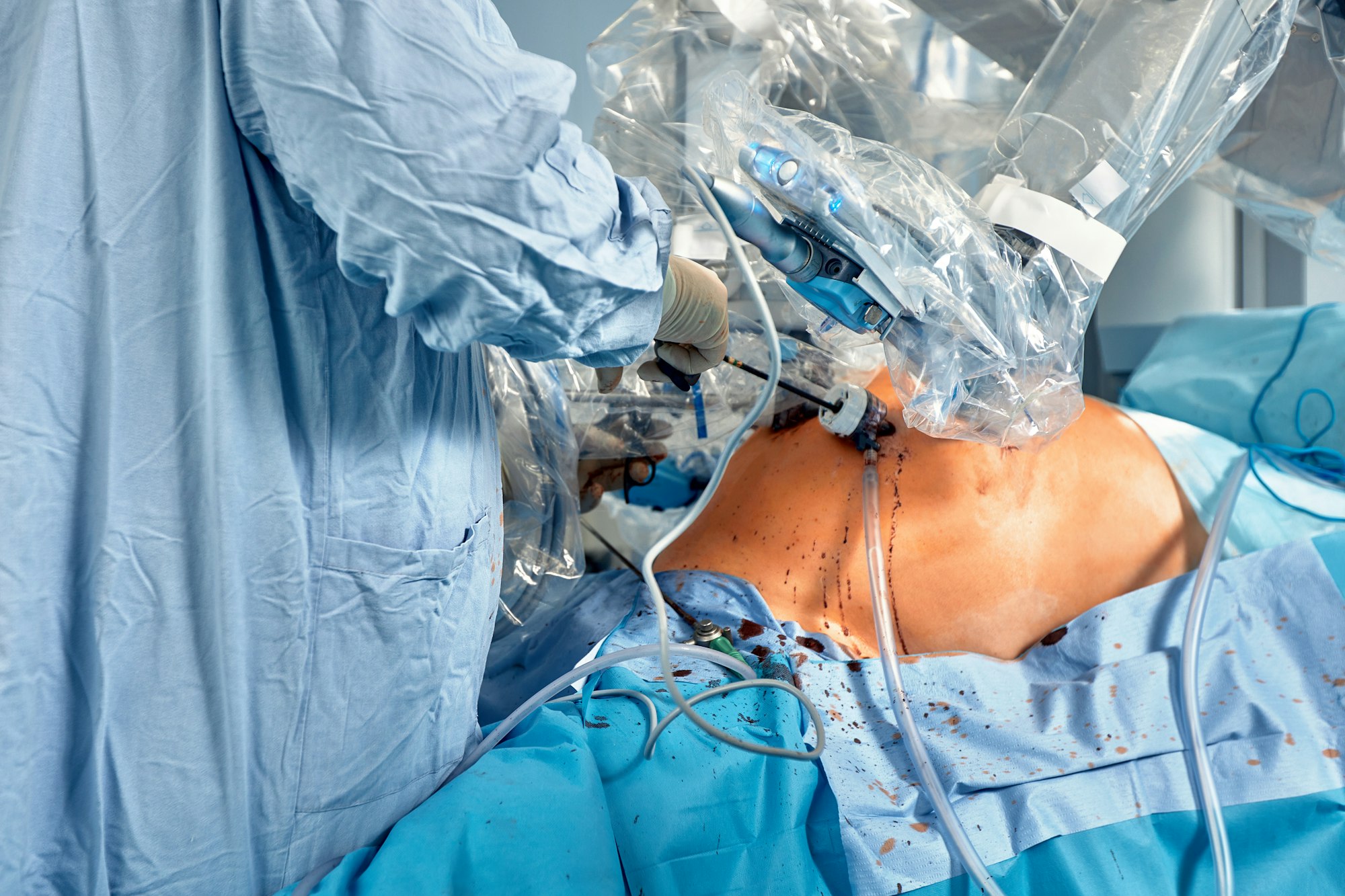 Sistem chirurgical robotizat minim invaziv în spital.